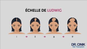 Alopécie (Chute des cheveux) Féminine et Masculine :-